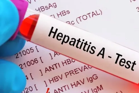 Waspadai Gejala Hepatitis A, Penyebab dan Cara Penularannya