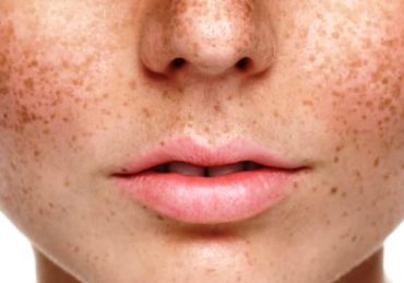 Cara Menghilangkan Bintik Hitam di Wajah dengan Bahan Alami