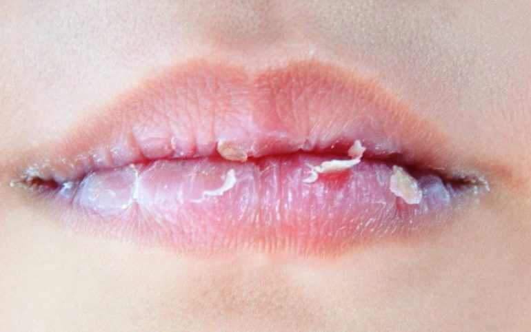 Tips Mengatasi Bibir Kering dan Mengelupas secara Alami Mudah Dilakukan